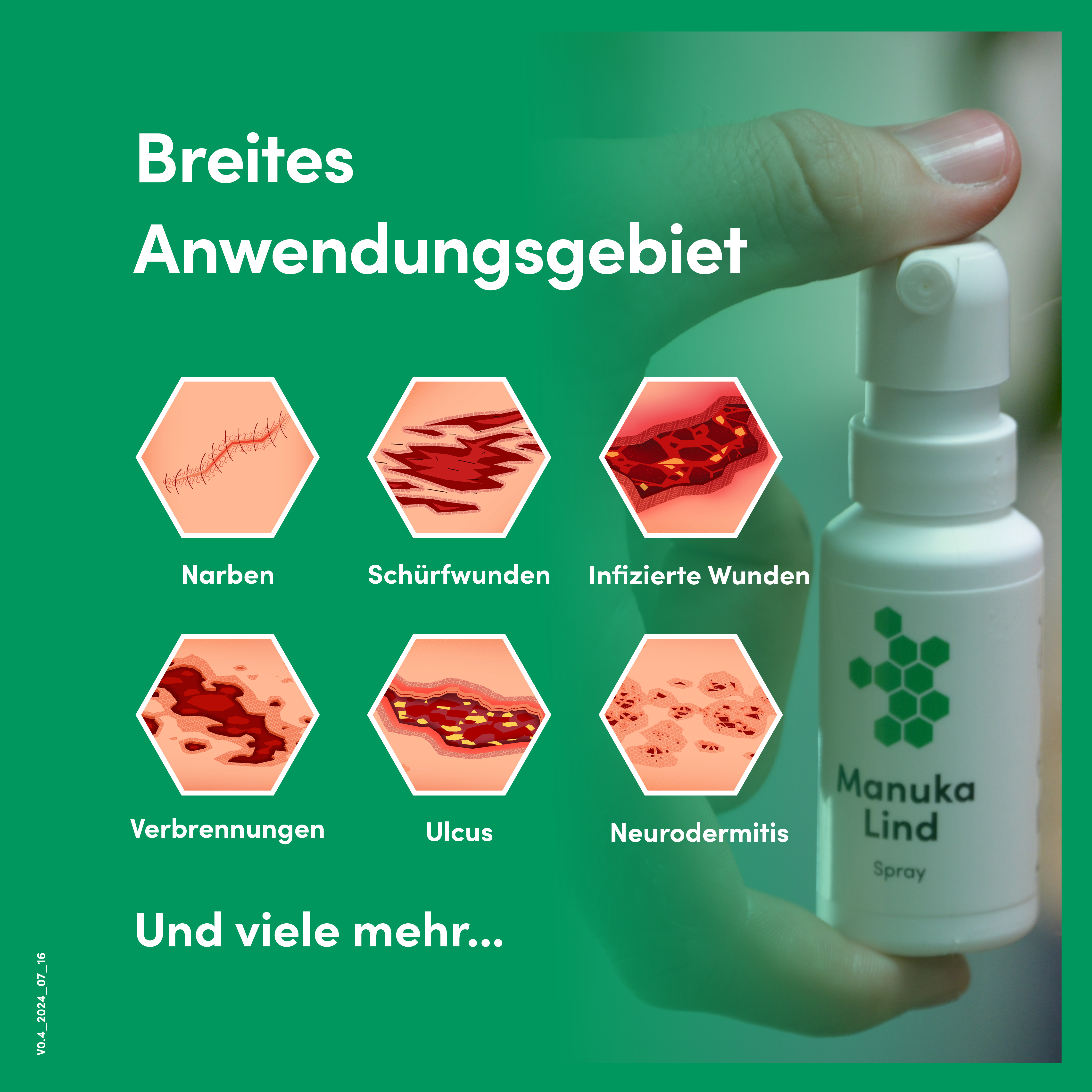 ManukaLind Wundheilspray mit antibakteriellem Manuka-Honig (MGO 514+), für alle Phasen der Wundheilung, viele Wundarten und Hautirritationen, Fördert die Heilung schwerwiegender Wunden, 30ml 